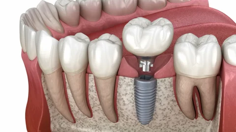 Dental Implant islamabad