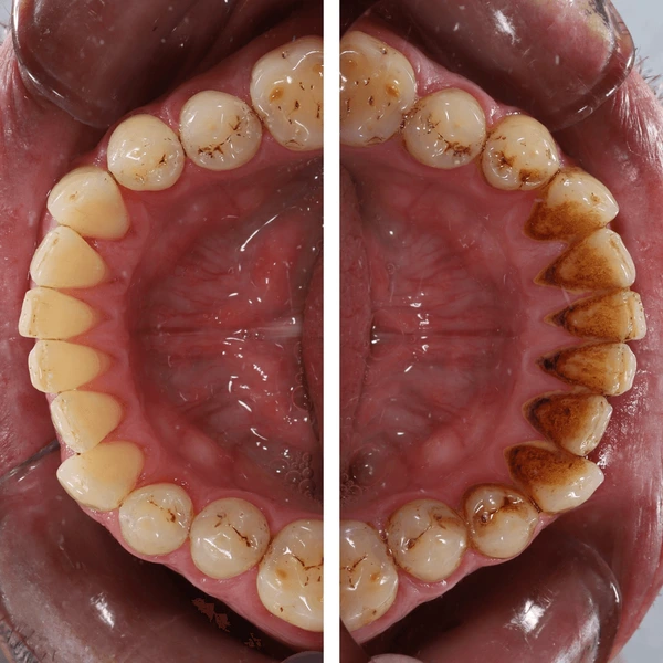 teeth-cleaning-islamabad-webp teeth cleaning scaling polishing Islamabad